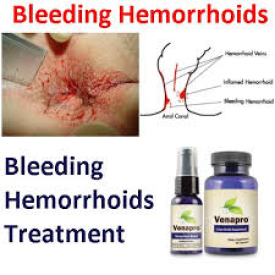 Treat HEMORRHOIDS