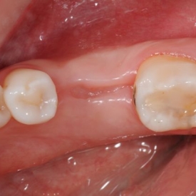 Bone after Tooth Extraction