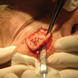 Mohs Surgery