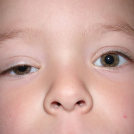 Cases of Ptosis