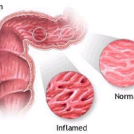 Crohns Diseases