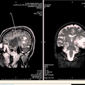 Brain Tumor – Meningioma