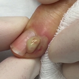 Finger infection Drainage