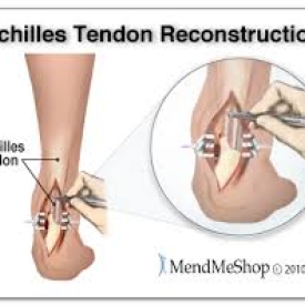 Achilles Tendon Rupture and Repair
