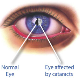 Secondary Cataract