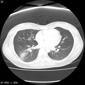 Chest X-ray: Air Crescent