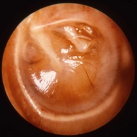 Endoscopic Glue Ear