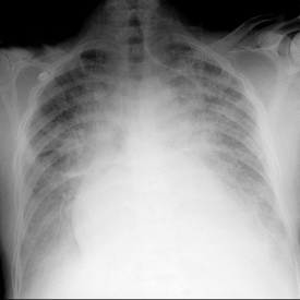 Chest X-ray: Pulmonary Edema