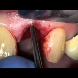 Removal of fractured tooth