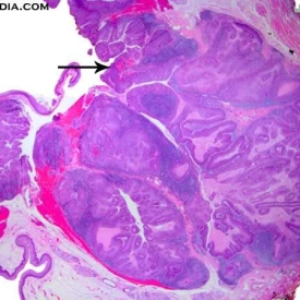 Histology of Pharyngeal Tonsil