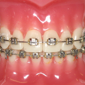 Dental Braces Procedure