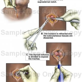 Tracheotomy Procedure Medical Animation