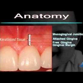 T2 Gingival Recession Diagnostic Guidelines