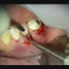 Periodontal Microsurgery-Grafting and Repair of flap tear